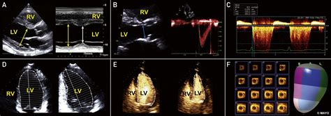 Echocardiographic Assessment of Left Ventricular .